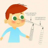 اختلال دید دو چشمی چیست؟