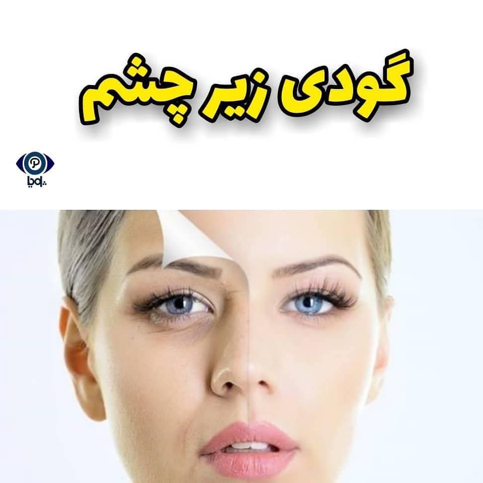 گودی زیر چشم